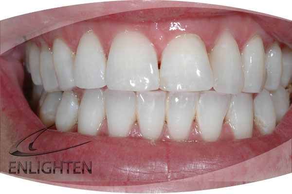 Photo before Enlighten Teeth Whitening Treatment