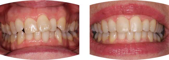 Before and after photographs of teeth straightening