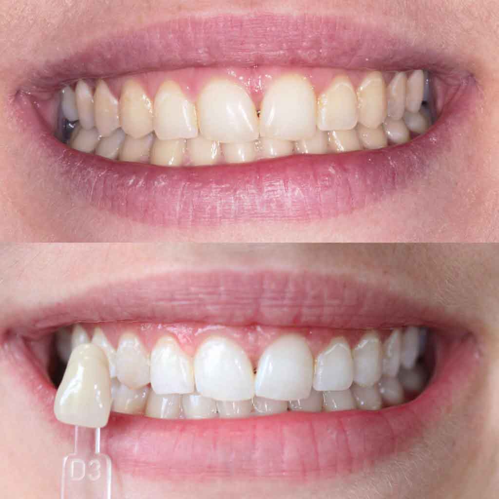 Photo-before-and-after-teeth-whitening